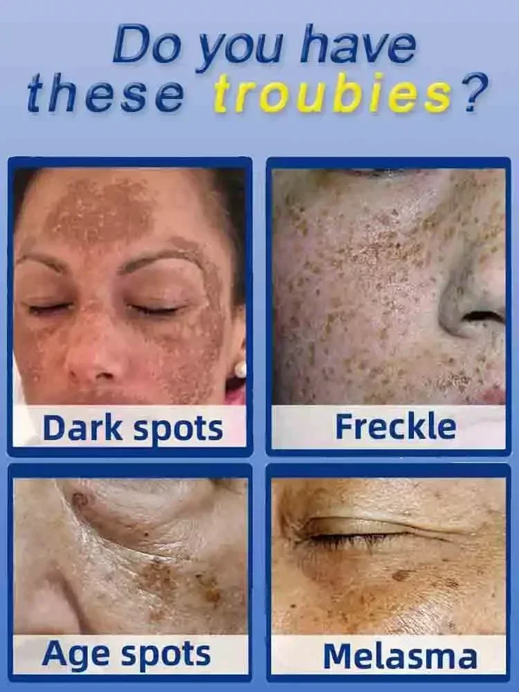 Dark Spot Remover for Face Rem - Charcoal Whitening Paste review and price