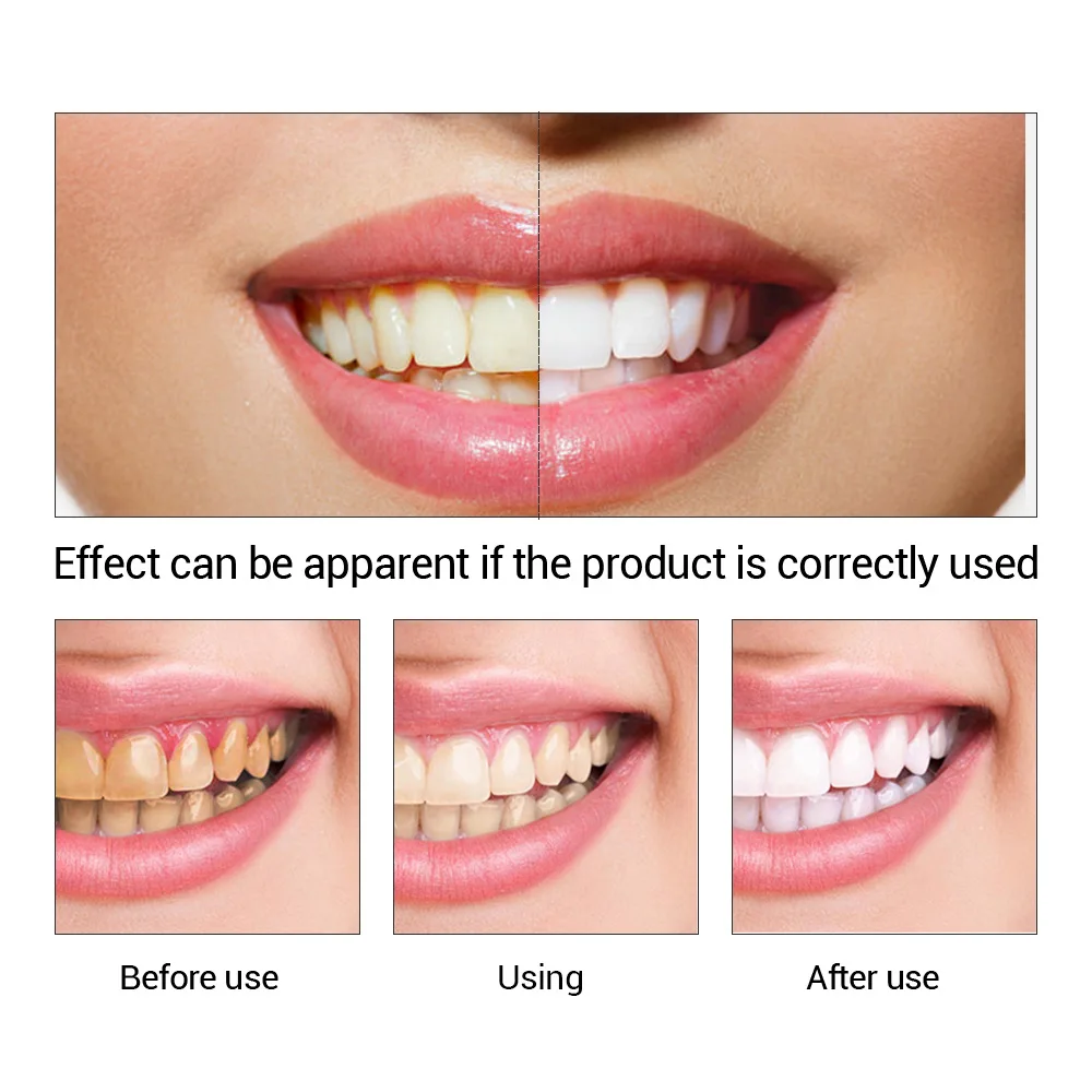 FTEENPLY Teeth Whitening Essen - Teeth Whitening Zimba review and price
