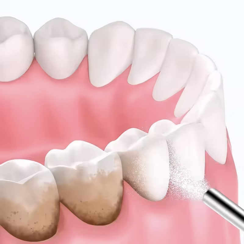 130g Dental Sandblasting Powde - Teeth Whitening Zimba review and price