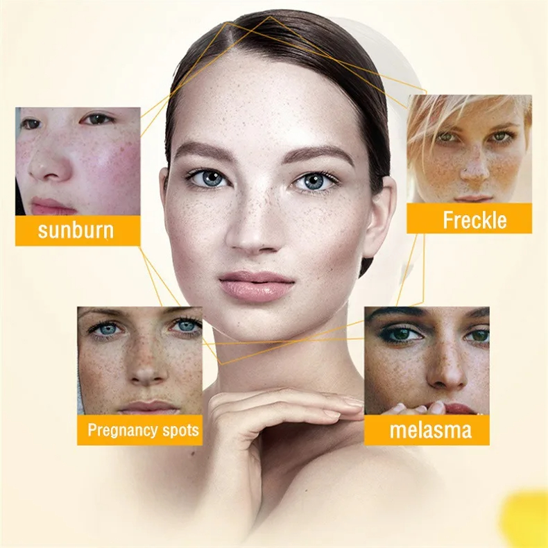 Whitening Freckle Cream Remove - Charcoal Whitening Paste review and price
