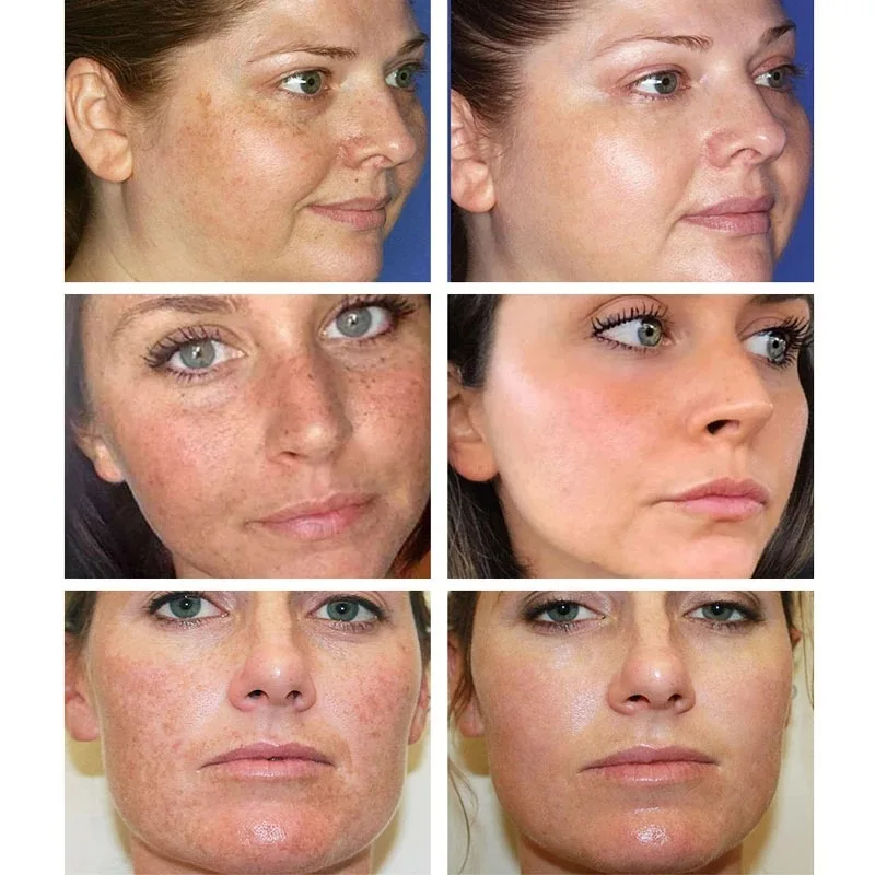Whitening Freckle Cream Remove - Charcoal Whitening Paste review and price