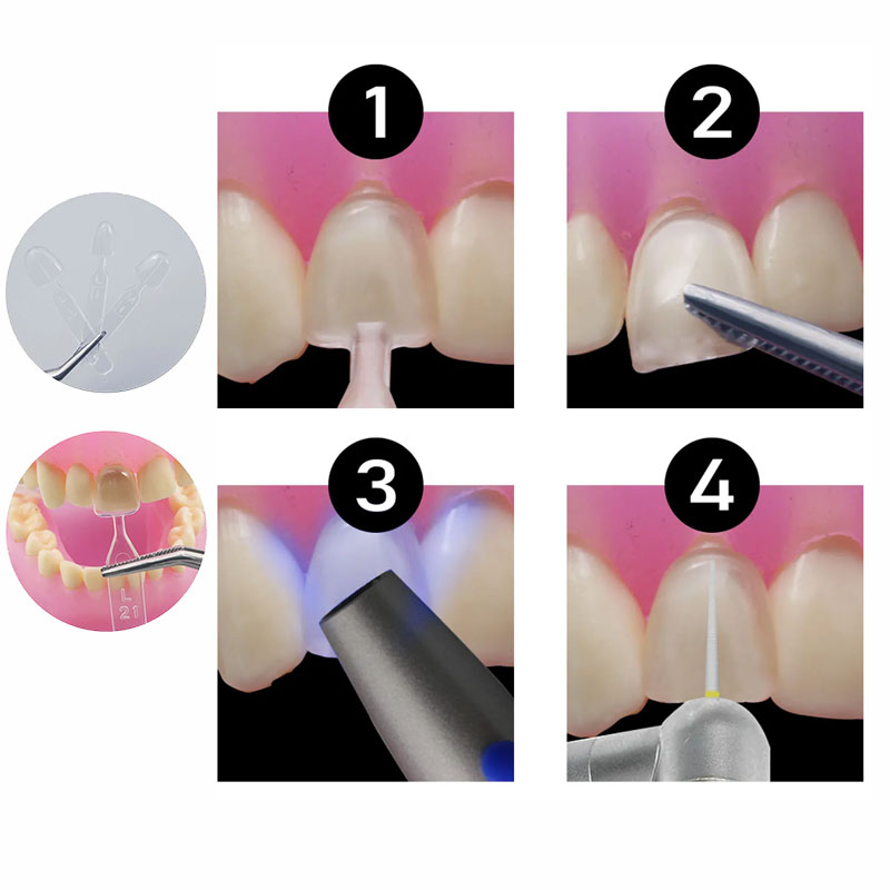 32pcs/Set Composite Resin Mold - Teeth Whitening Moulds review and price