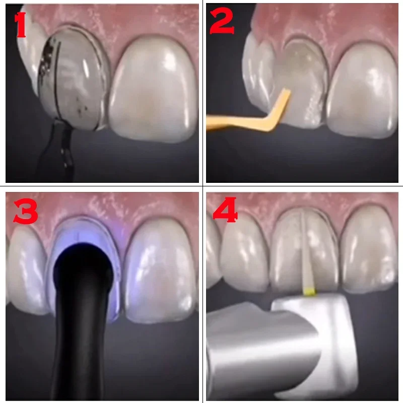 Dentals Mould For Composite Re - Teeth Whitening Moulds review and price
