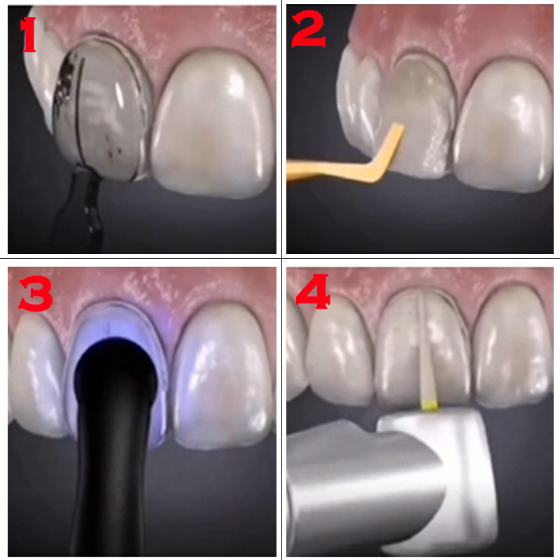 32pcs Dental Veneer Mould Kit  - Teeth Whitening Moulds review and price