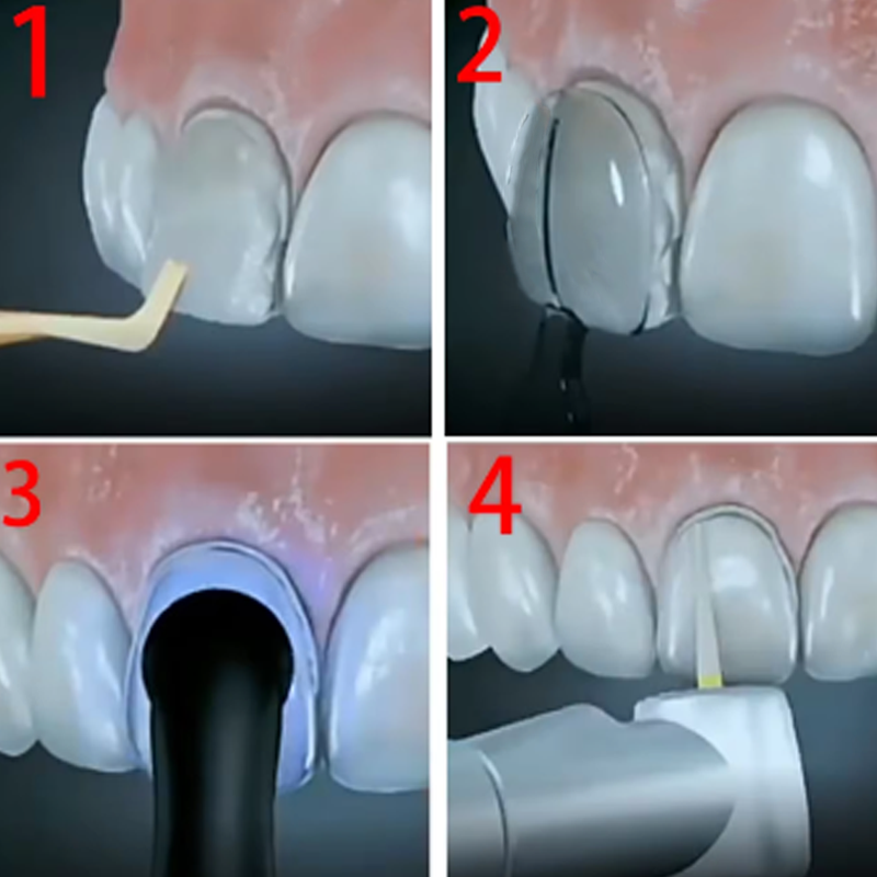 32Pcs/Box Dental Veneer Mould  - Teeth Whitening Moulds review and price